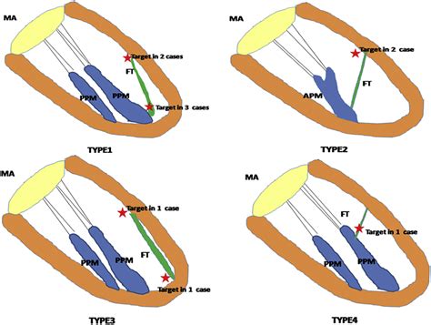 false ventricular tendons